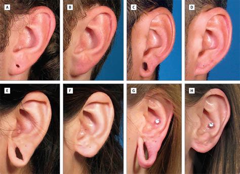 Reconstructing the Gauge Earlobe Defect | JAMA Facial Plastic Surgery | The JAMA Network