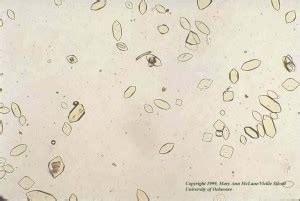 Uric Acid Crystals in Urine | Medical Laboratories