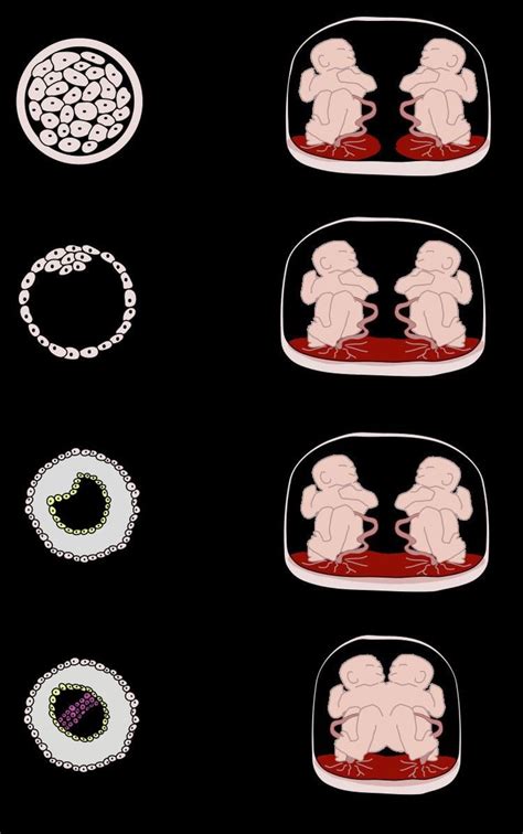 Monoamniotic twins - Alchetron, The Free Social Encyclopedia