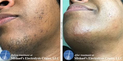 Before & After Electrolysis Hair Removal | Mishael's Electrolysis Center