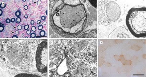 Results of Sural Nerve Biopsy, Electron Microscopy, and Muscle Biopsy | Download Scientific Diagram