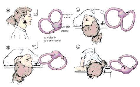 Epley Maneuver - Modified Epley Maneuver For Treating Right Sided Bppv ...