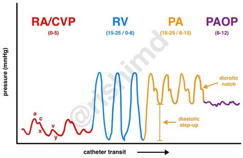 Pulmonary Artery Catheter/Swan-Ganz Structure, Waveforms, And Interpreting The Numbers - RK.md ...