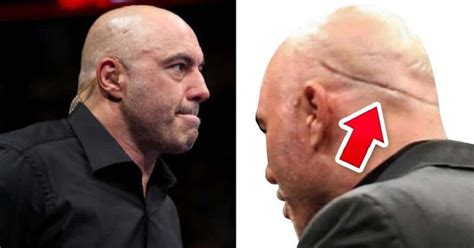 Joe Rogan Hair Transplant