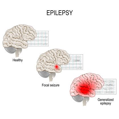 Epilepsy Eeg Of Healthy Brain And Epileptic Seizure Stock Illustration - Download Image Now - iStock