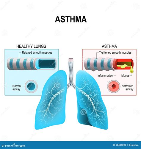 Asthma. Humans Lungs and Bronchi Stock Vector - Illustration of ...