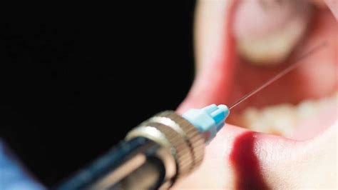 ph of dental local anesthetics