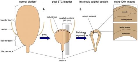 (A) The bladder body is excised leaving the trigone and ureterovesical... | Download Scientific ...