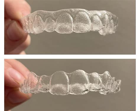 Smile Direct Club vs. Invisalign : r/Invisalign