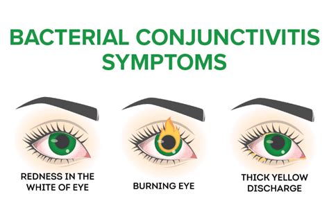 Allergic Conjunctivitis Vs Bacterial Conjunctivitis