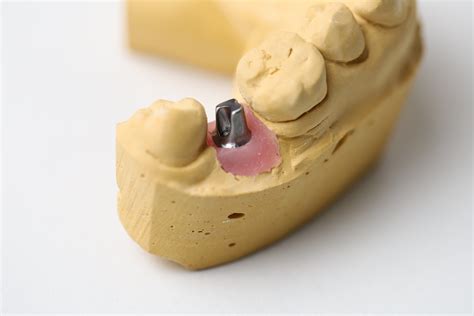 Customized Abutment