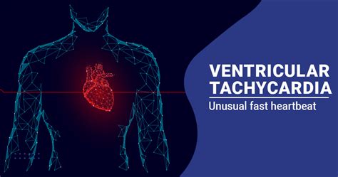 Ventricular Tachycardia – Causes, Symptoms and Treatment