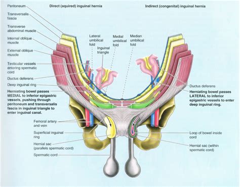 Direct Inguinal Hernia Anatomy