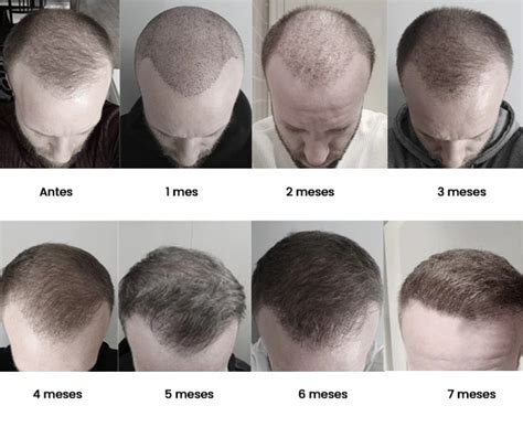 Hair Transplant Recovery: Day 1 to 12 Months - EasyHairHub