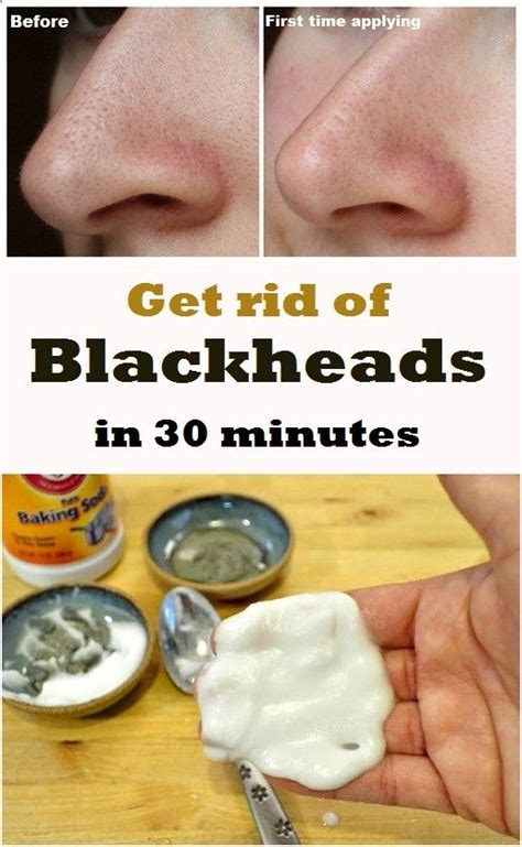 Remove Blackheads in 30 minutes | Blackhead remedies