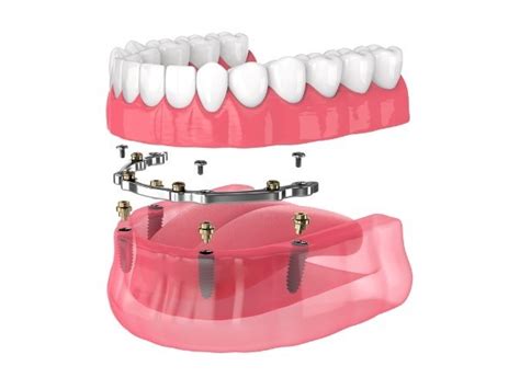 What is The Bar Attachment Denture Dental Implant Technique?