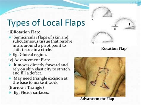 Skin grafts and skin flaps