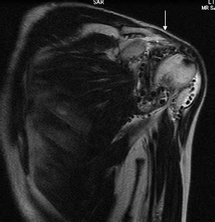 Synovial Osteochondromatosis of Shoulder - Sumer's Radiology Blog