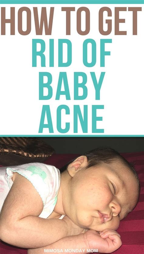 HOW TO GET RID OF BABY ACNE - AN INSTANT REMEDY! + The Baby Acne Treatment We Used!! - Momma ...