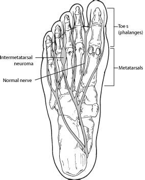 Morton’s Neuroma – Symptoms of Morton’s Neuroma | Foot Health Facts - Foot Health Facts