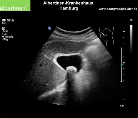 Chronic Cholecystitis - DocCheck