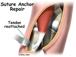 What is a Biceps Tendon Rupture and How is it Fixed? - Beacon Orthopaedics & Sports Medicine