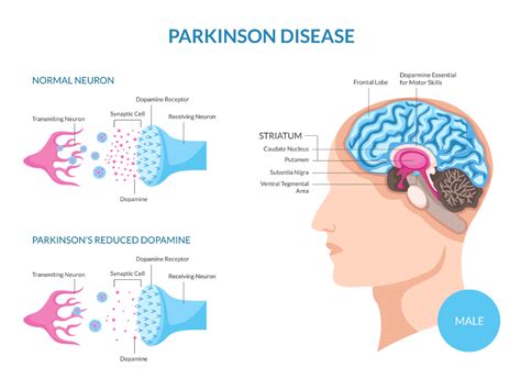 Parkinson's - Nutritional Therapist, Tavistock, Devon and the South West - Fiona Waring