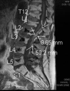 Lumbar Epidural Hematoma after Neuraxial Pain Procedure in a Patient ...