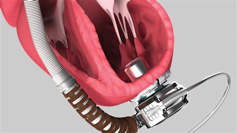 Medical Device Animation: Heartware System LVAD Pump - YouTube