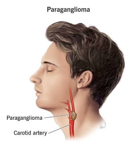 Visual representation of Paraganglioma - MEDizzy