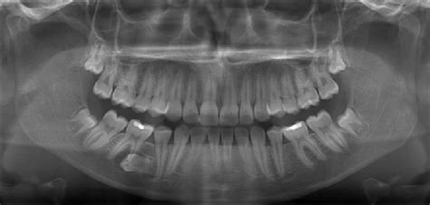 Panoramic radiograph revealing the impacted right mandibular second ...