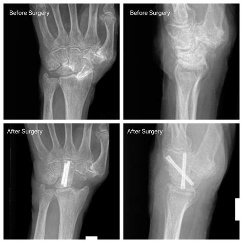 SLAC wrist arthritis - John Erickson, MD