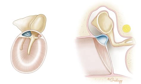 Cholesteatoma | Ento Key