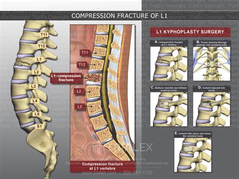 Compression Fracture of L1 - TrialQuest Inc.