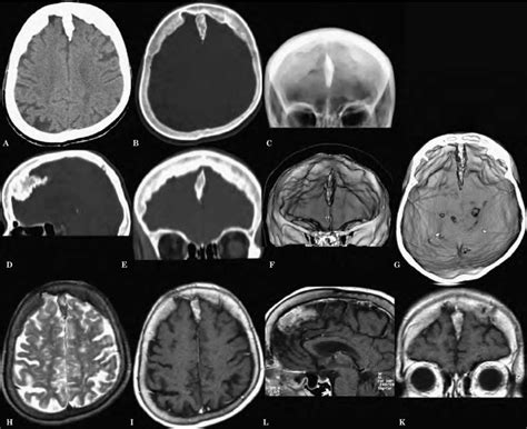 Falx cerebri ossification. A,B) Axial CT scans with soft tissue and... | Download Scientific Diagram