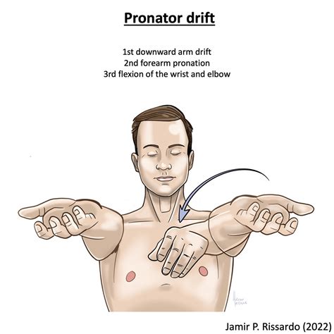 Drifts!!! French neurologist Jean Alexandre Barré (1880–1967) # ...