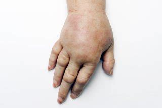 Swollen arms and hands (oedema) - NHS