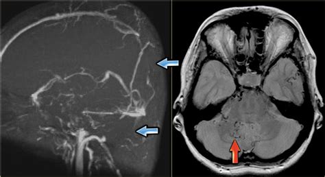 Dural Venous Thrombosis