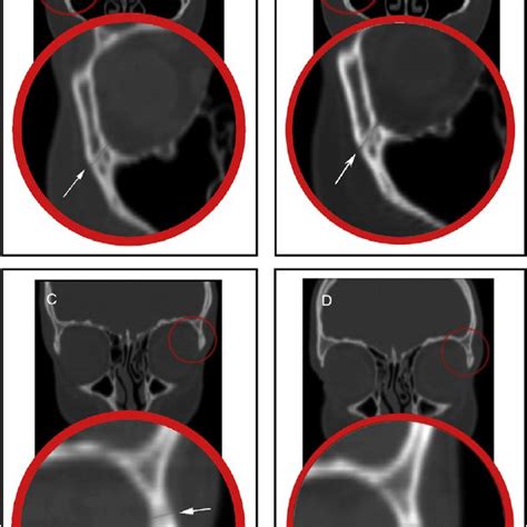 Sagittal CT sections showing: A, the pterygomaxillary suture before ...