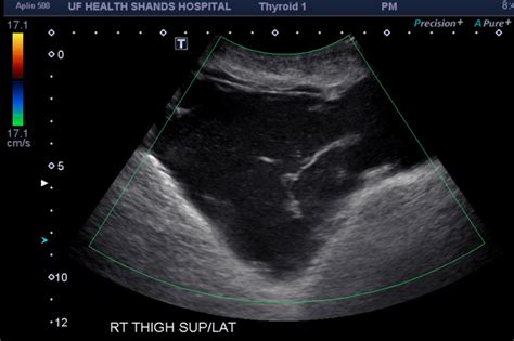 Morel-Lavallée Lesion - Ultrasound | Download Scientific Diagram