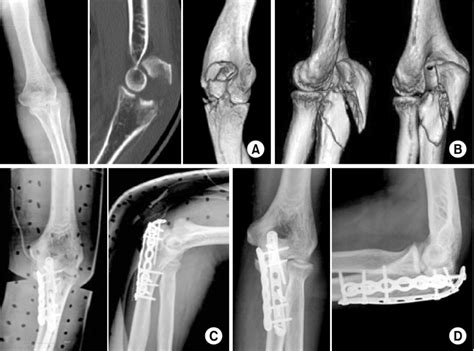 (A) Preoperative simple radiographs showed Mayo type IIB olecranon ...