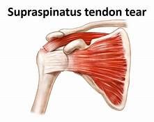 Supraspinatus And Infraspinatus Tendons