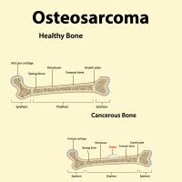 Myxofibrosarcoma: Causes, Symptoms And Treatment