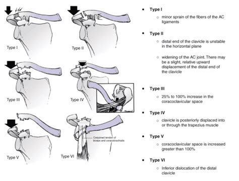 AC Joint Injury | Reflex Health