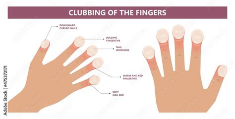 Nail clubbing. Symptoms tetralogy of Fallot bone swelling warning sign toenails coughing ...