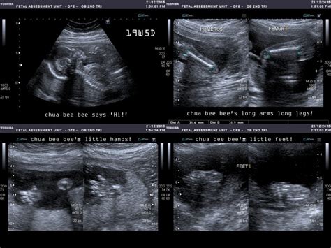 Pregnancy: The second trimester - 20-week anomaly scan + gestational diabetes scare ⋆