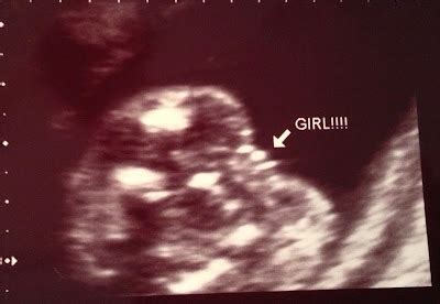 How to Make a Smile: Baby Girl - 20 week ultrasound