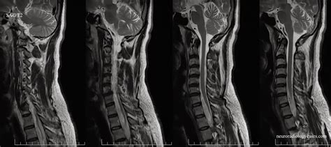 Dr Balaji Anvekar FRCR: Focal Adhesive Arachnoiditis of Spinal Cord