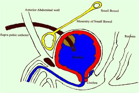 Figure 1 from An Unusual Complication of Suprapubic Catheter Insertion | Semantic Scholar