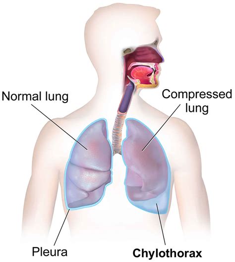 Chylothorax definition, causes, symptoms, diagnosis & treatment